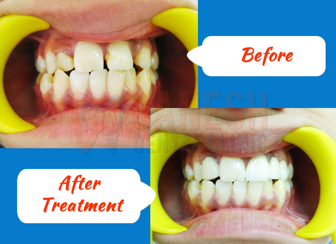 ganesh dental before after treatment