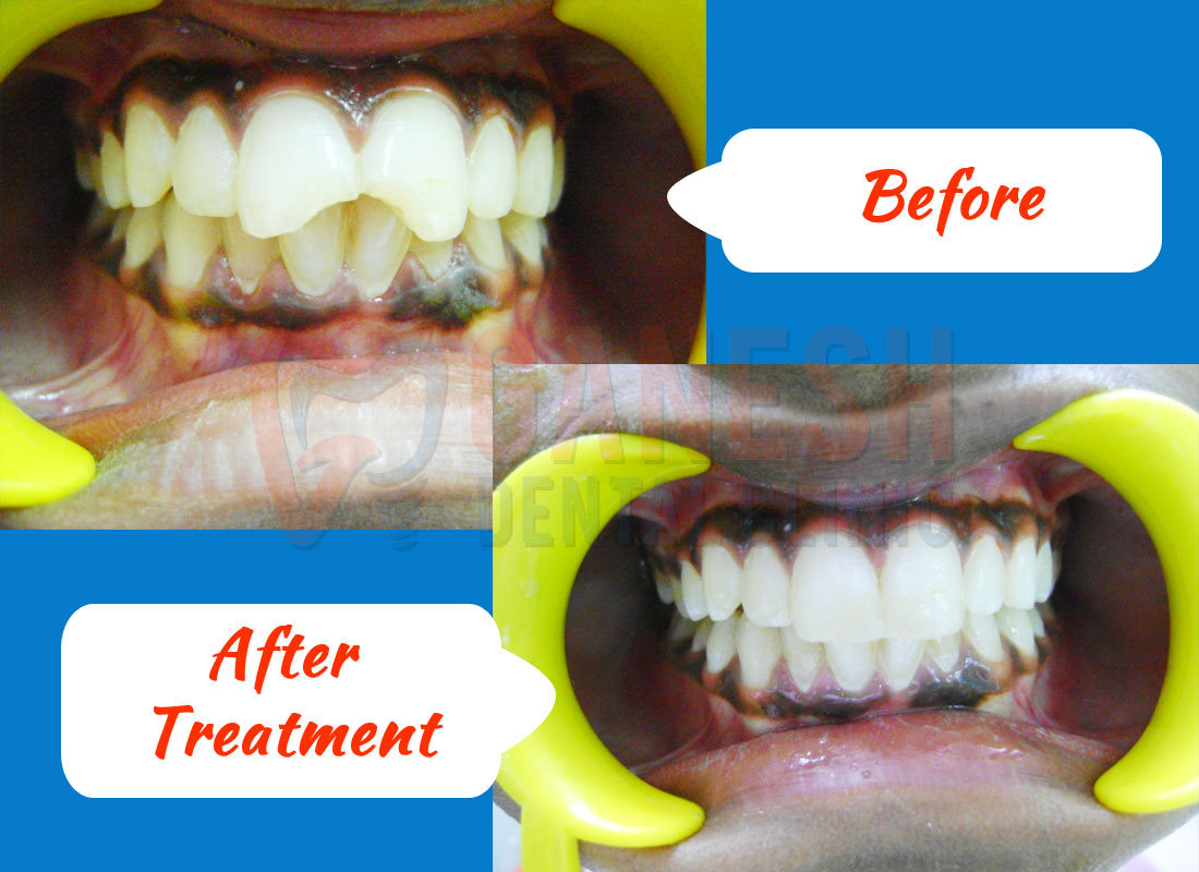 ganesh dental before after treatment