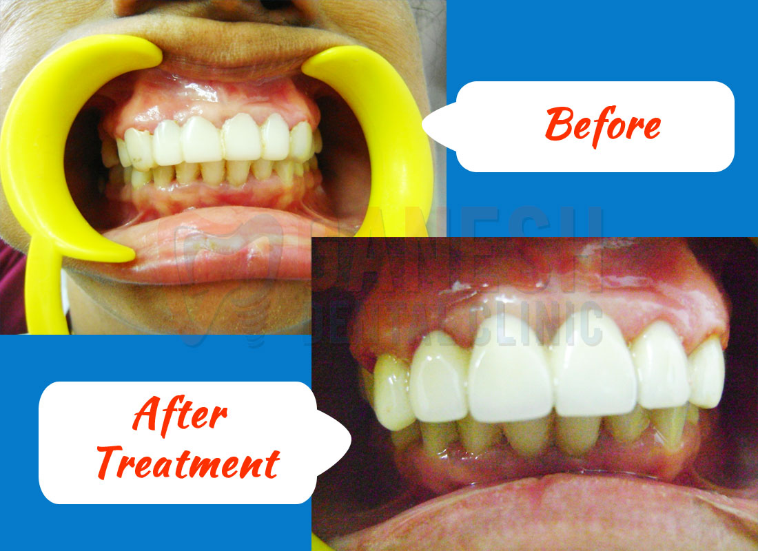ganesh dental before after treatment