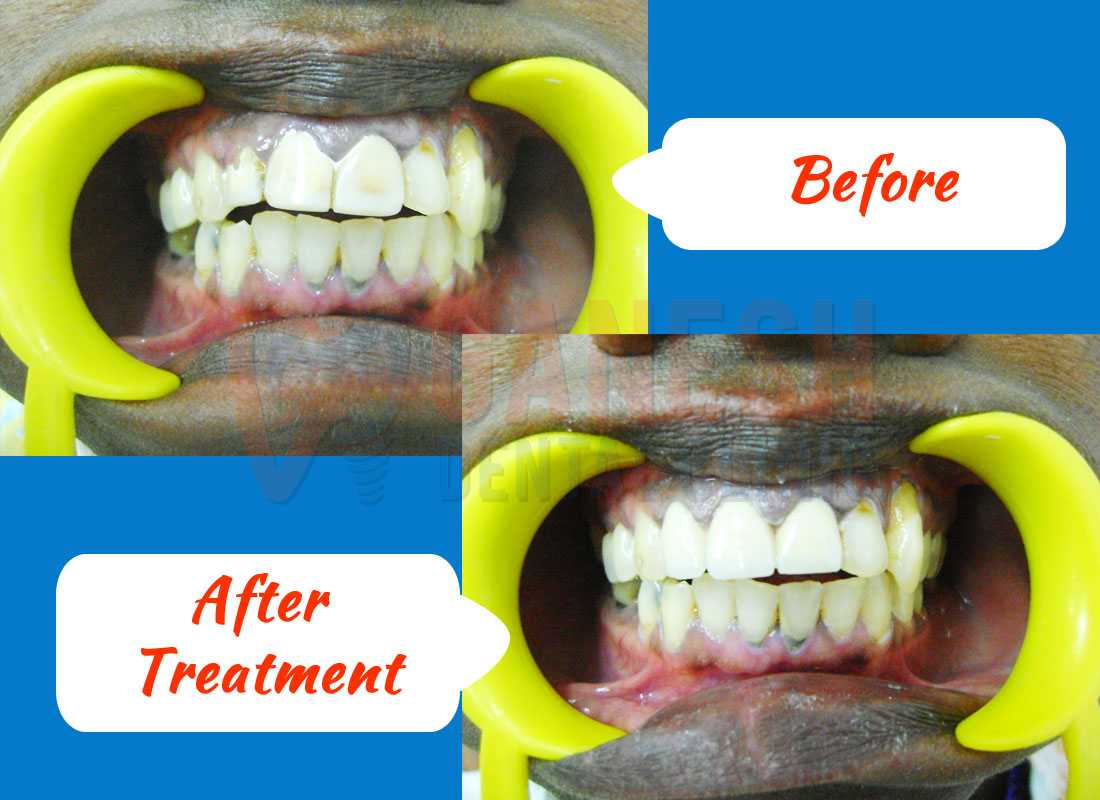 ganesh dental before after treatment