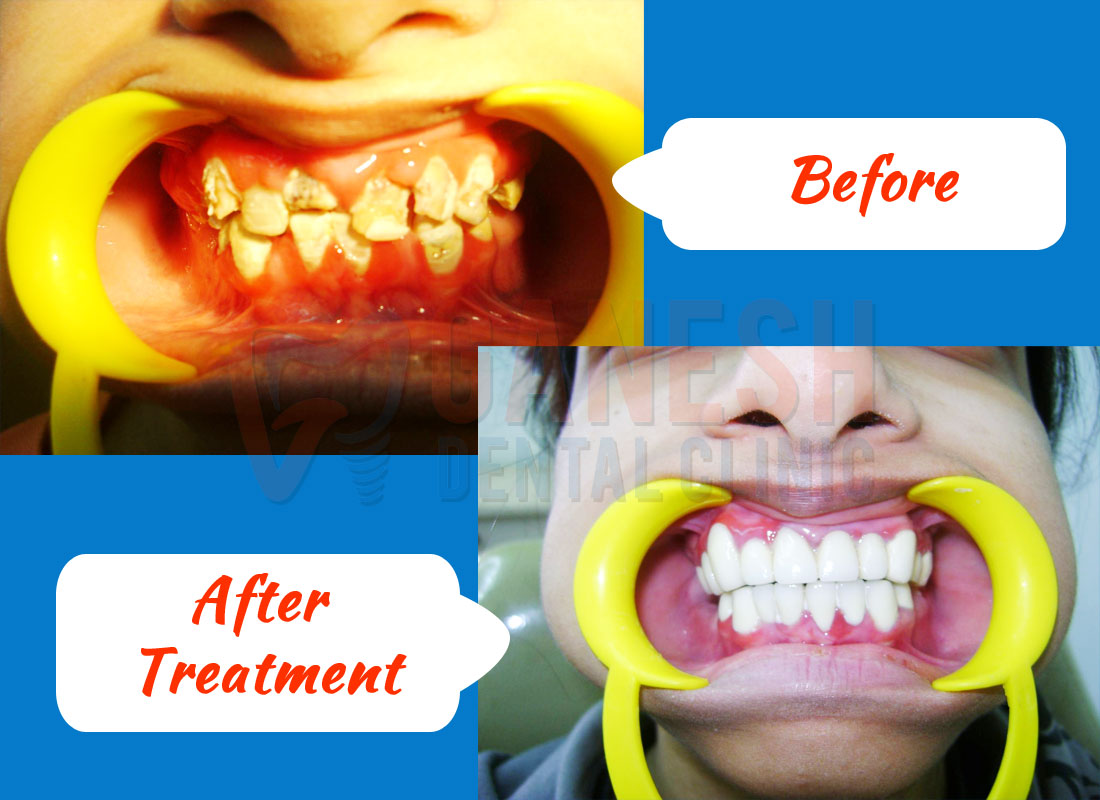ganesh dental before after treatment