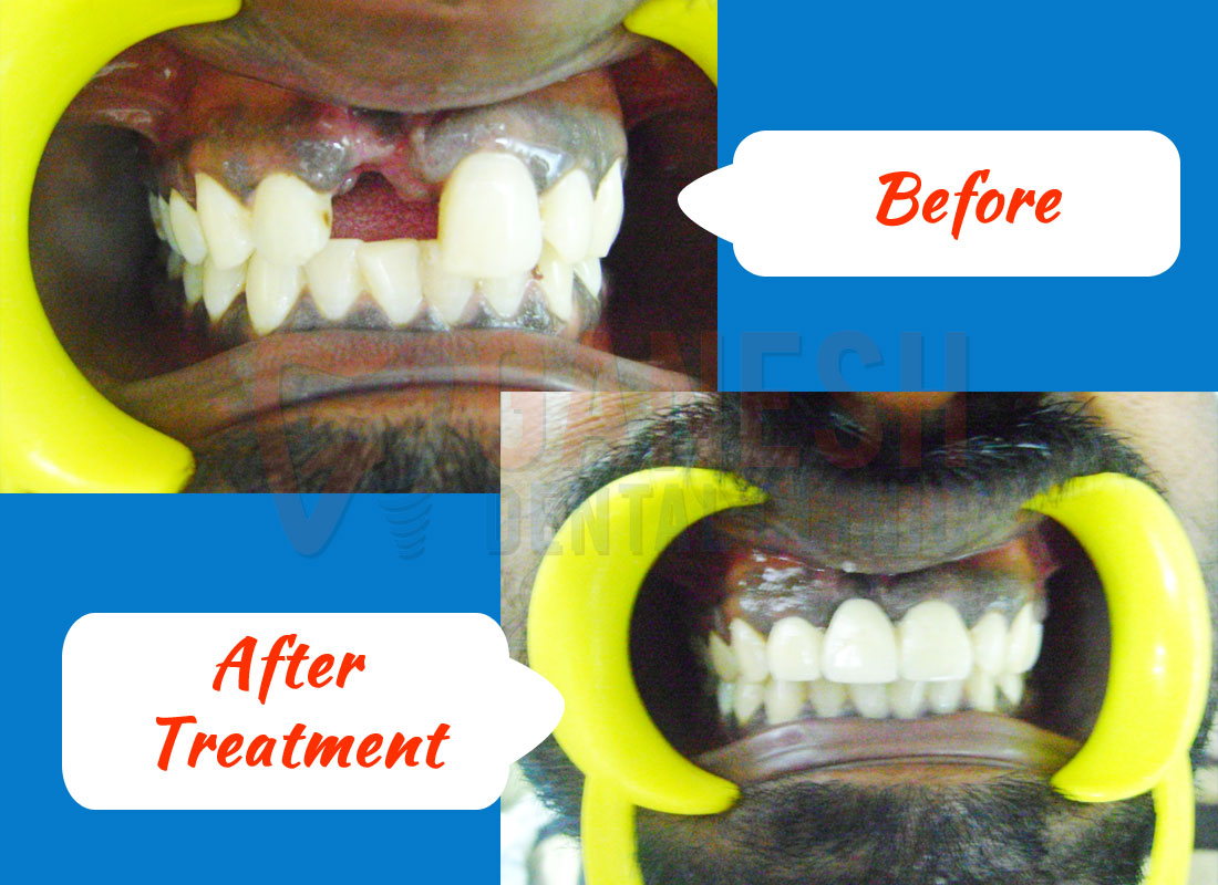 ganesh dental before after treatment