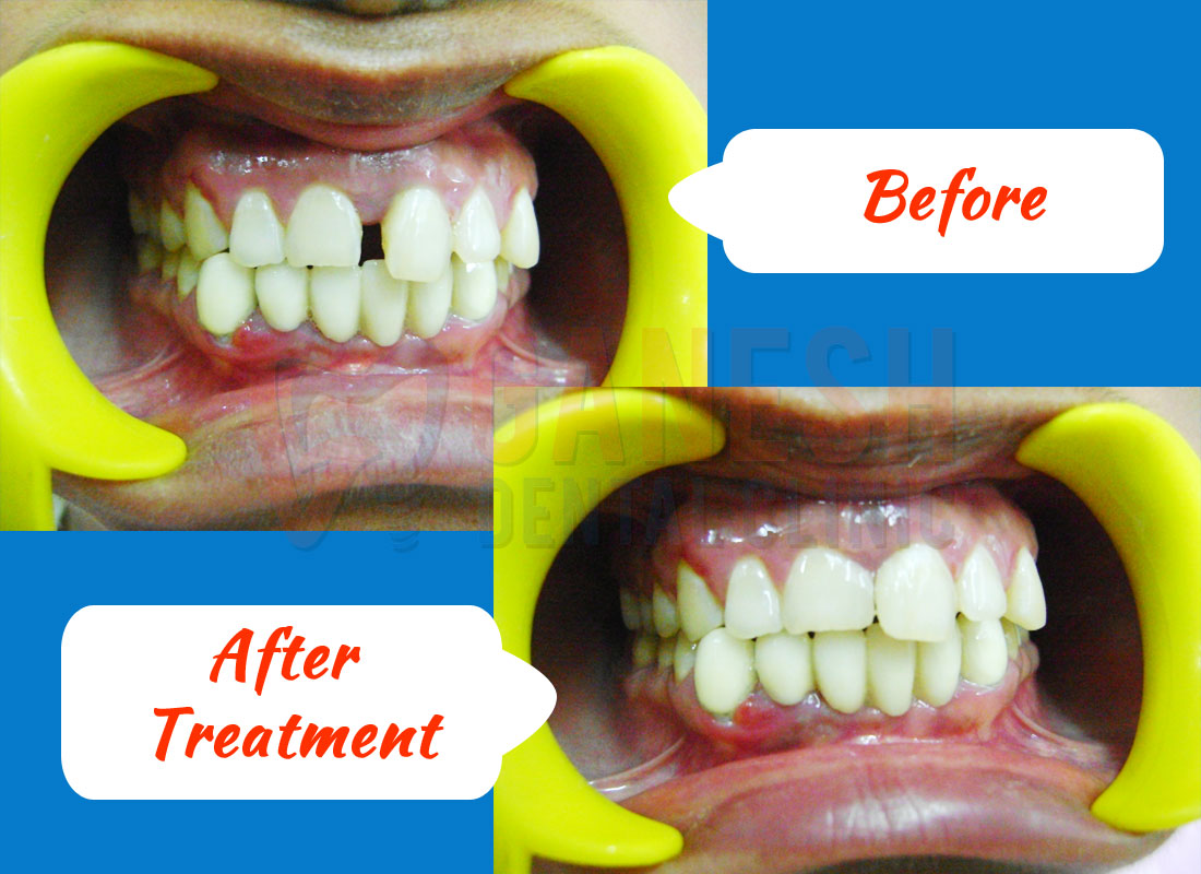 ganesh dental before after treatment