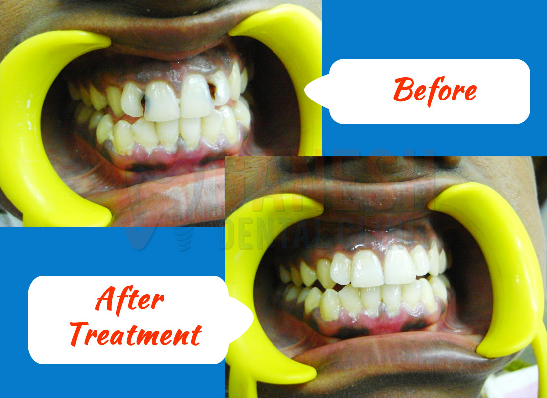ganesh dental before after treatment