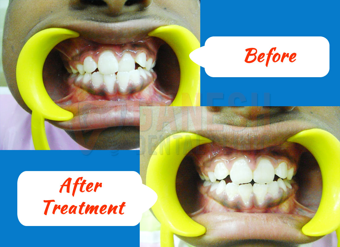 ganesh dental before after treatment