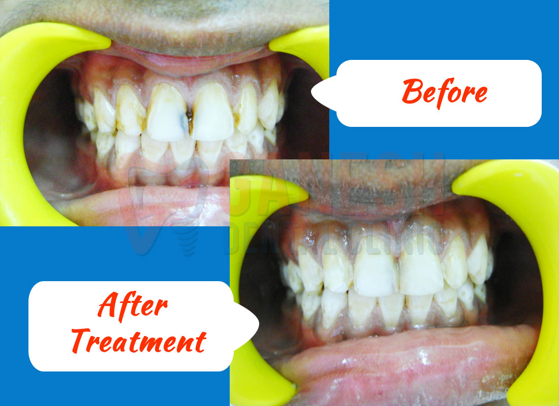 ganesh dental before after treatment